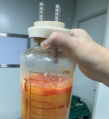 临汾水动力吸脂手术要做多久？